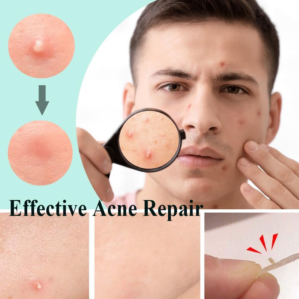 300 Acne Patches - Invisible Hydrocolloid Spot Stickers for Day and Night, Waterproof and Breathable - Image 4