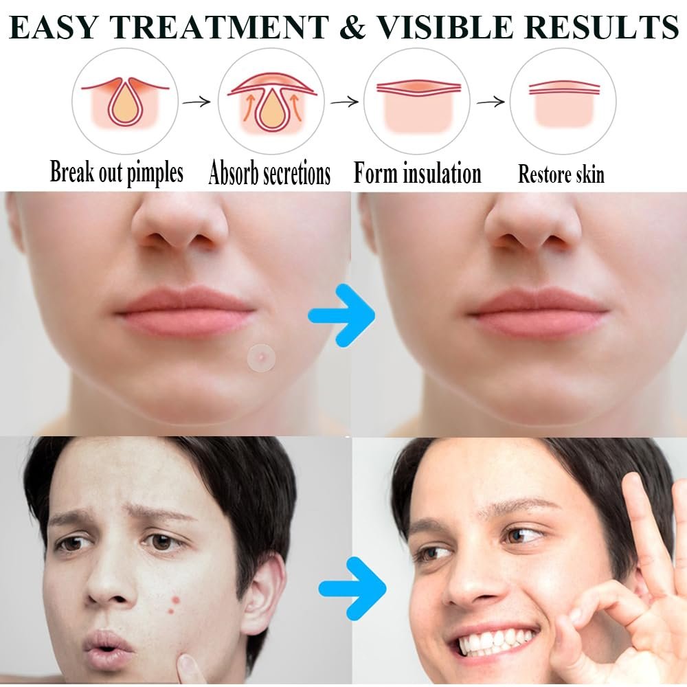 300 Acne Patches - Invisible Hydrocolloid Spot Stickers for Day and Night, Waterproof and Breathable - Image 2